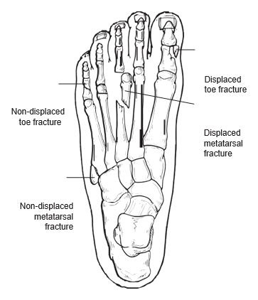 toe fracture